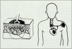 Picture of somato-visceral nerve reflex. Richard L. Van Buskirk 1990