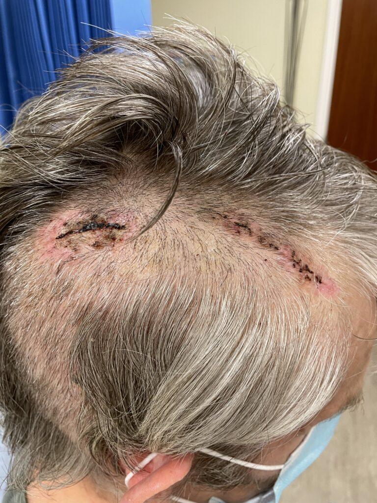 post burr hole surgical scars