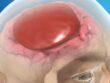 picture of subdural haematoma on human brain
