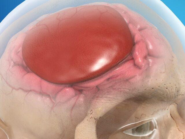 picture of subdural haematoma on human brain